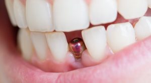 implant zębowy w dziąśle